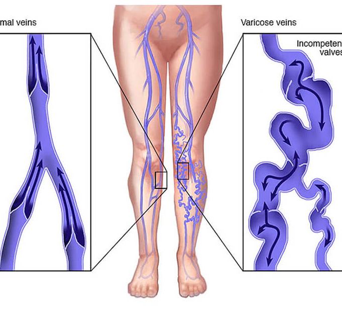 Варикозные Узлы На Ногах