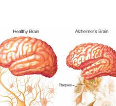 Слабоумие – болезнь Альцгеймера