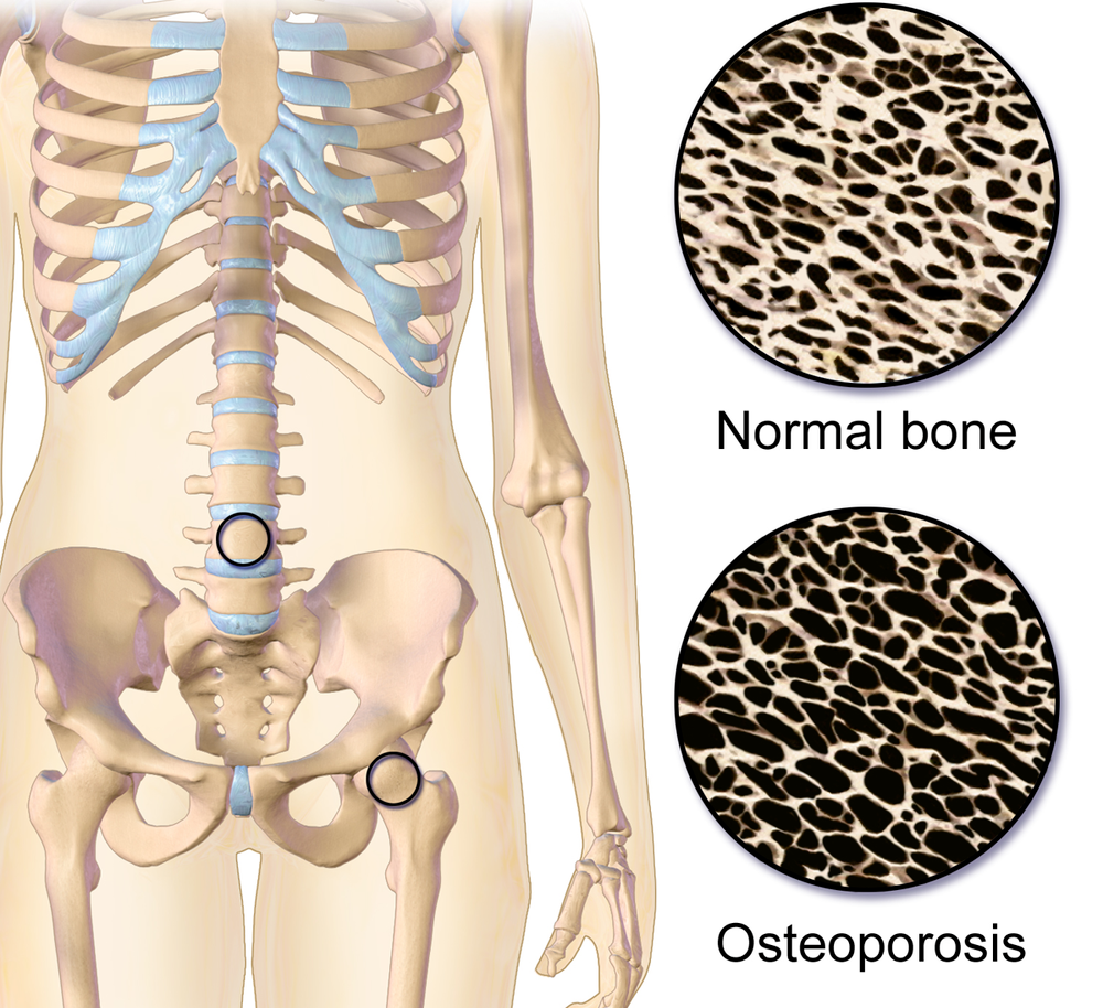 Здоровье костной ткани. Кость при остеопорозе. Здоровая кость и остеопороз. Нормальная кость.