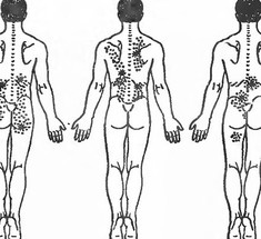 Люмбаго или замороженная спина: упражнения на растяжение мышц