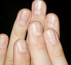 Полоски на ногтях: откуда они и что это значит