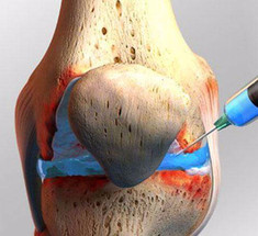 5 лучших противовоспалительных средств для выведения жидкости из колена