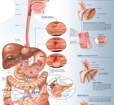 «Дырявый кишечник»: Патологические процессы при синдроме повышенной кишечной проницаемости