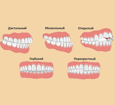 ВАЖНО! Связь прикуса и проблемы с опорно-двигательным аппаратом — взгляд остеопата