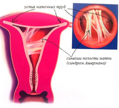 Синдром Ашермана, или последствия врачебной помощи
