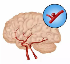 Аневризма сосуда головного мозга: 4 признака, которые должен знать каждый 