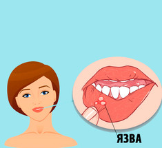 Язвы во рту: натуральные способы лечения