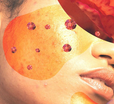 Розацеа на лице: Средства, которые помогут снять покраснение и зуд 