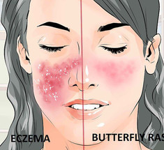 Присмотритесь к своей коже: как проявляются ревматические болезни 