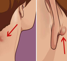 Что нужно знать, если у вас есть такое уплотнение на шее или за ухом