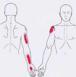 Триггеры: Карта точек боли и напряжения в теле 