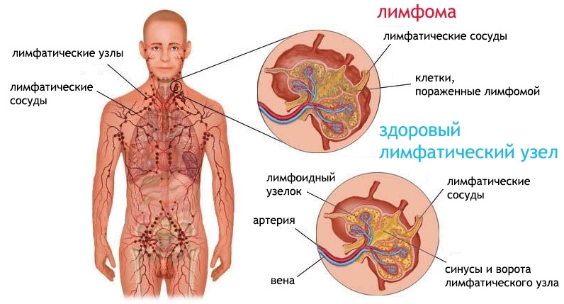 Рецепты народной медицины при лимфоме Ходжкина