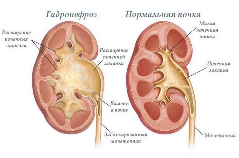 ПОЧЕЧНЫЕ КАМНИ — сгустки ГНЕВА