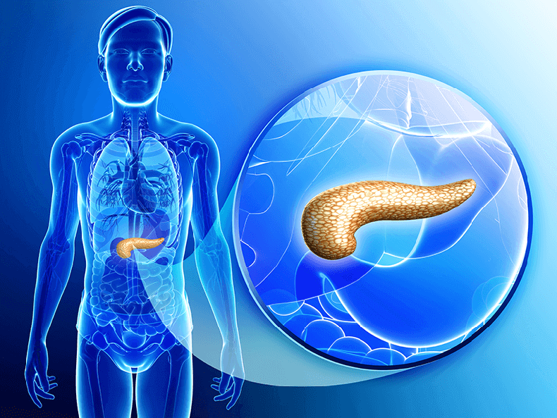 Стеатоз поджелудочной железы: Что делать, если железа начинает перерождаться в жир