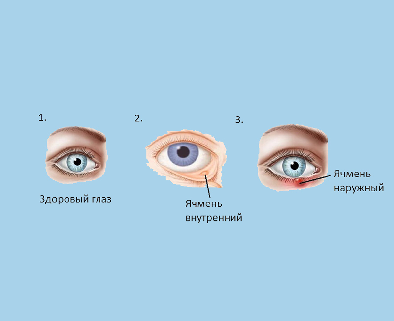 Ячмень на глазу: 8 актуальных и безопасных способов борьбы 