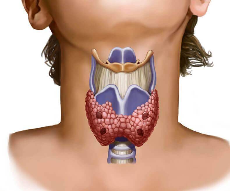 Щитовидная железа и лишний вес: Симптомы эндокринной патологии