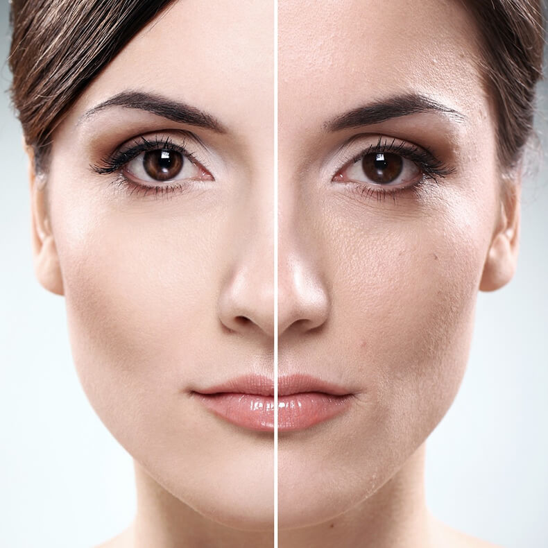 Расширенные поры на лице: лучшие решения для проблемной кожи