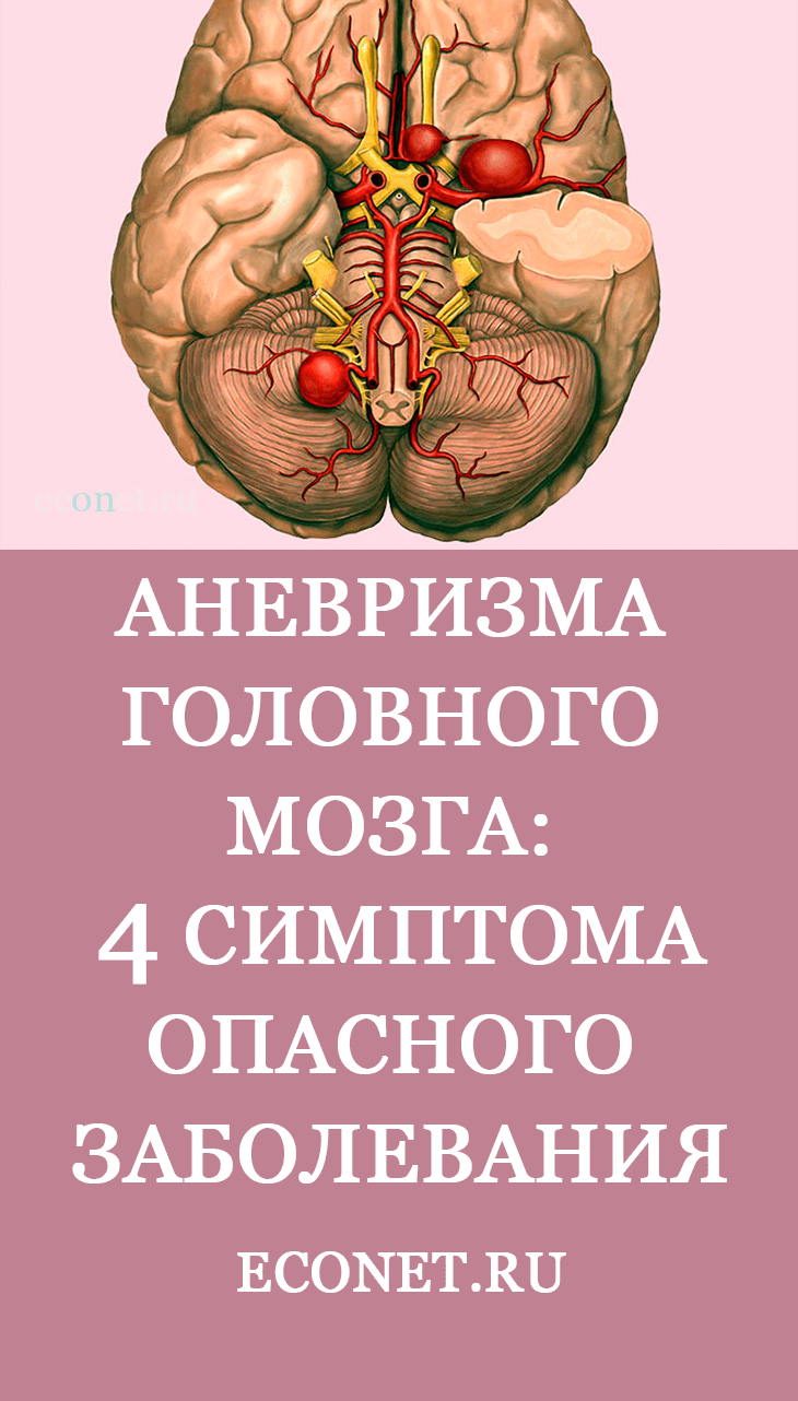 Аневризма головного мозга: 4 симптома смертельно опасного заболевания