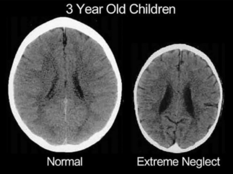 Чем отличается мозг 3-х летнего карапуза от мозга ребёнка, подвергавшегося эмоциональному отвержению