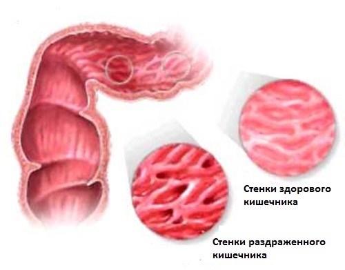 Что можно есть при синдроме раздраженного кишечника?