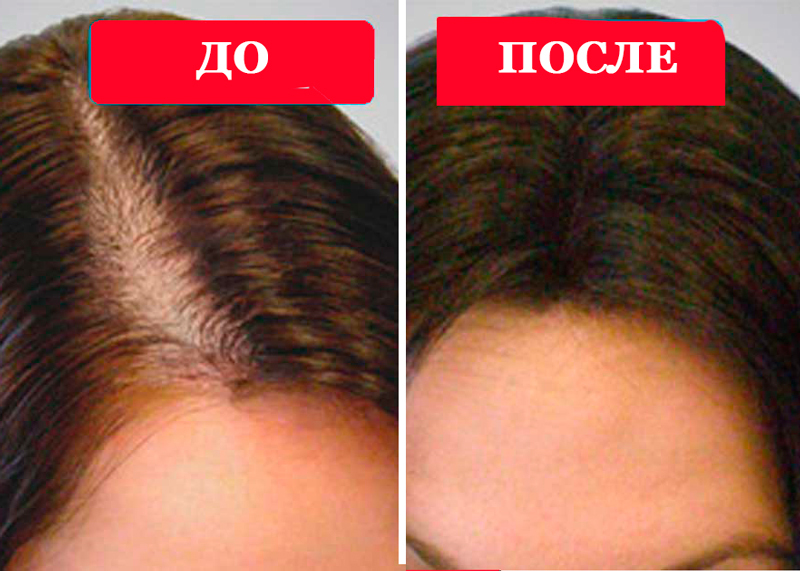 Живица – чудо-средство от выпадения волос