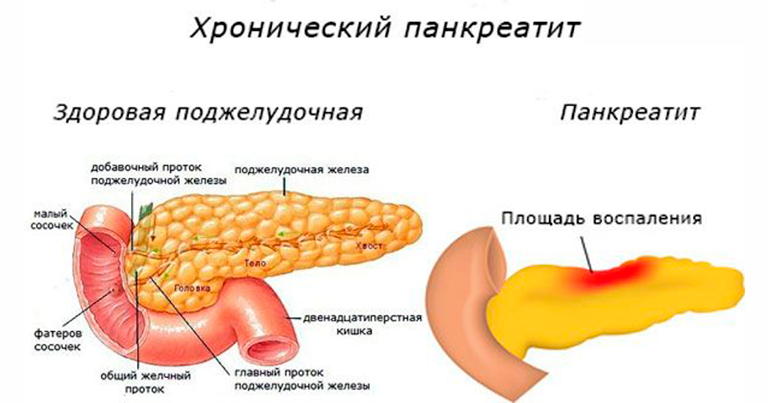 Панкреатит фото больных