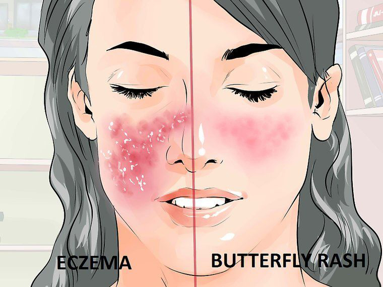 Присмотритесь к своей коже: как проявляются ревматические болезни 