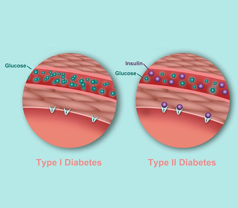 10 распространенных мифов о диабете 1 и 2 типа