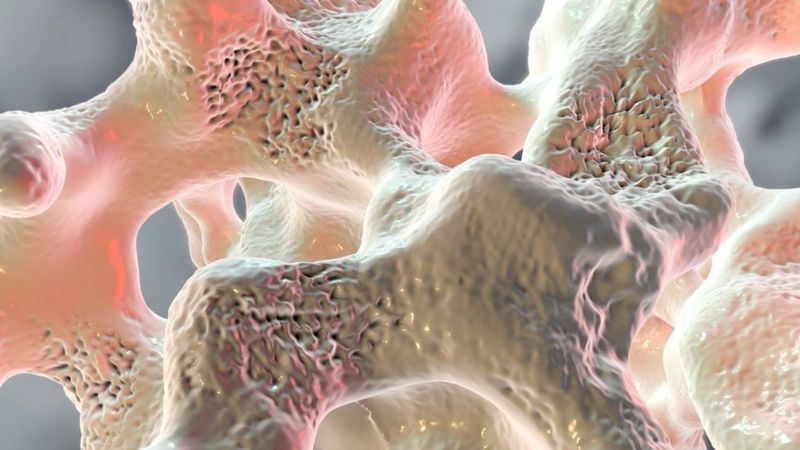 9 естественных подходов к борьбе с остеопорозом и потерей костной массы