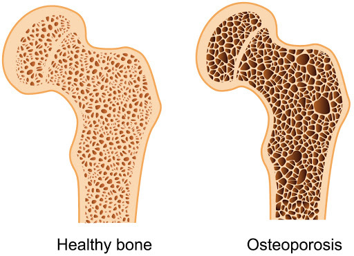 9 естественных подходов к борьбе с остеопорозом и потерей костной массы